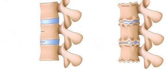a healthy spine and osteochondrosis