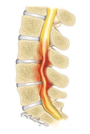 With osteochondrosis of the thoracic spine, compression of the spinal canal occurs. 