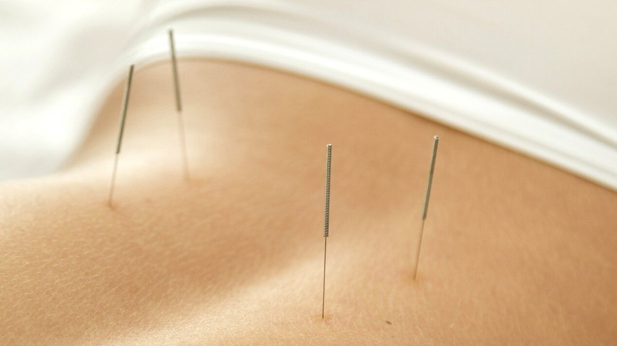 Acupuncture will help eliminate lower back pain