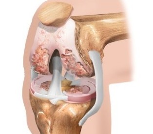 The cartilage of your knee