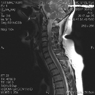 The osteochondrosis and spondylosis in the cervical region of the spine